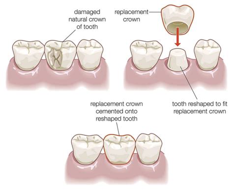 dental crowns healthy smiles  abington