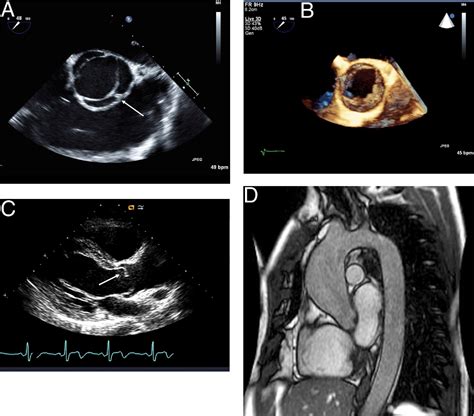 Bicuspid Aortic Valve Disease Journal Of The American College Of