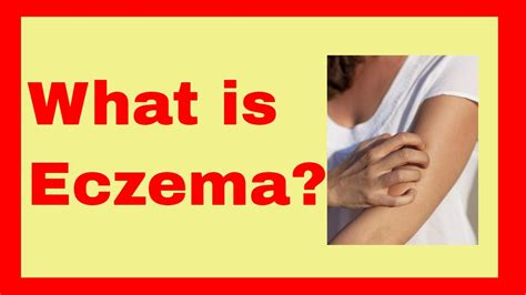 What Is Eczema Causes Types Treatment Cure Youtube