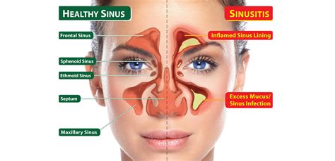 the best 6 sinus infection home remedies health and love