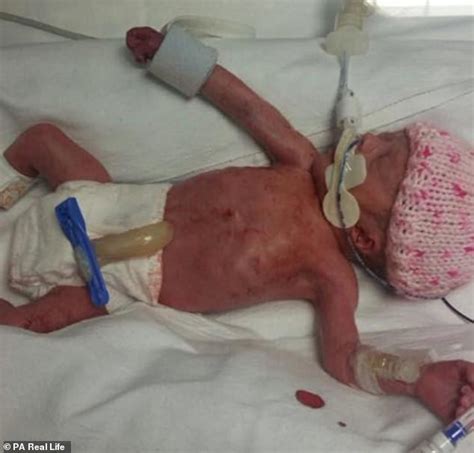 Mum Of Three Warns Women Of The Dangers Of Cesarean Sections After A
