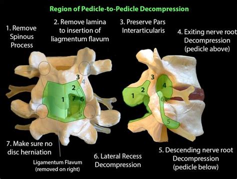 Cauda Equina Syndrome Spine Orthobullets