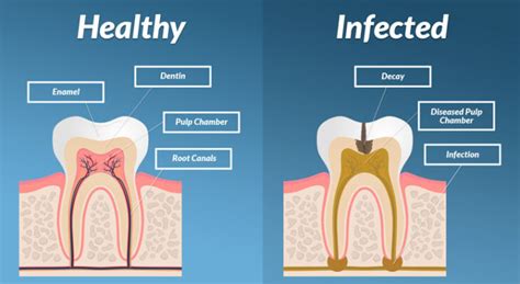 symptoms  tooth infection spreading  body