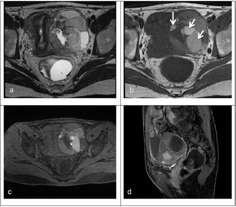 mri features  primary  metastatic mucinous ovarian tumors semantic scholar