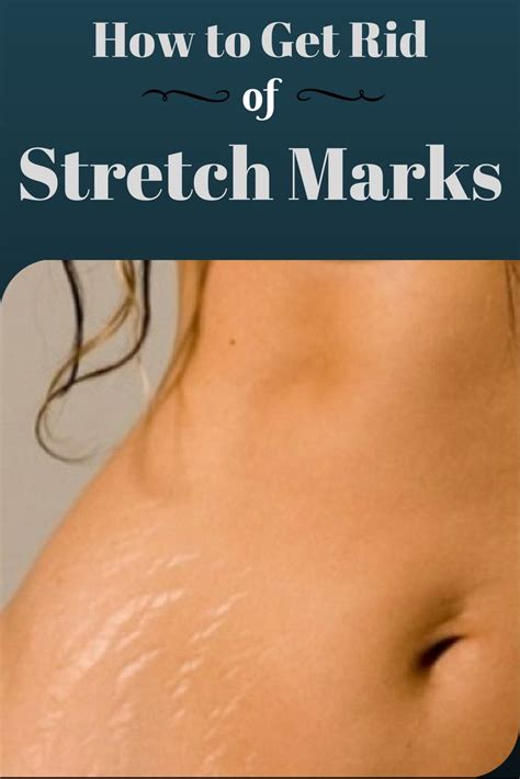 How To Get Rid Of Stretch Marks At Home 2 Stretch Marks Skincare
