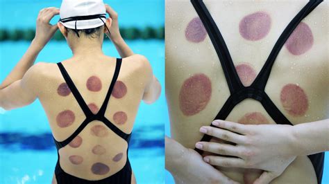 olympic cupping a practice rooted in ancient islam big