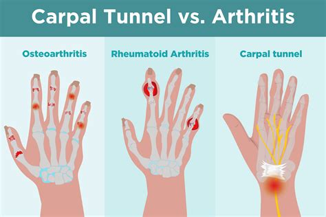 Osteoarthritis And Rheumatoid Arthritis Of The Wrist Usasc And Orthopedics