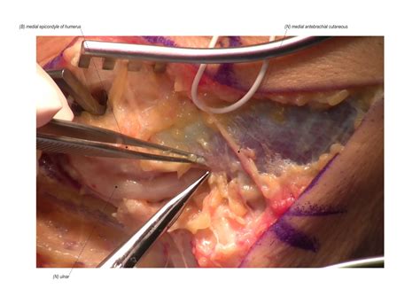 Submuscular Ulnar Nerve Transposition Surgical Education