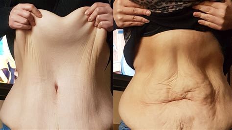 Loose Skin After Weight Loss Learn How To Tighten It