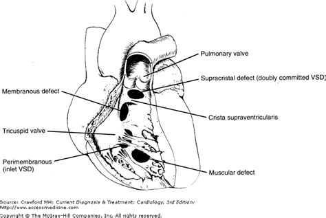 lets learn diseasesymptomstest  drug  ventricular septal