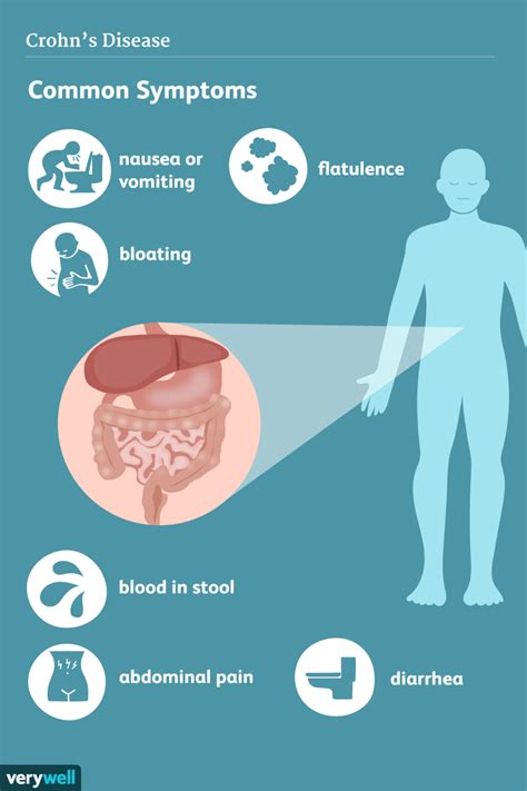 crohn s disease signs and symptoms