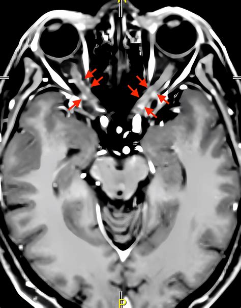 cureus primary central nervous system lymphoma presenting  optic