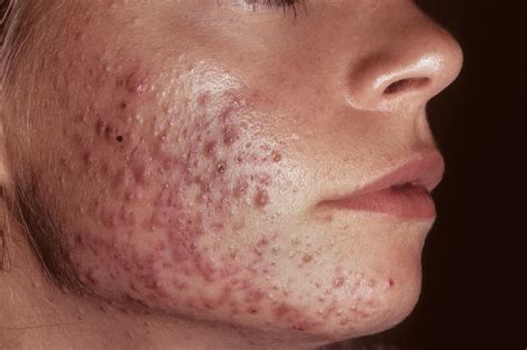 hormonal antiandrogen therapy  acne   reduce antibiotic