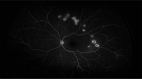 Disseminated Chorioretinitis With Unknown Etiology Retina Image Bank