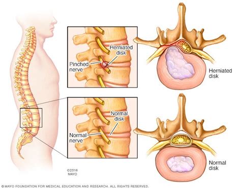 Illustration Of A Herniated Disk Herniated Disc Pinched