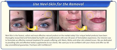nevi skin skin tag removal cream and mole remover cream