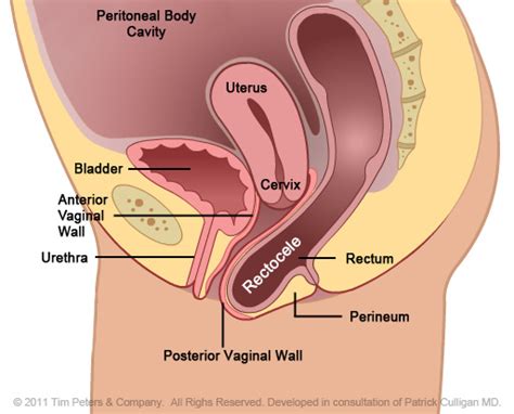 Rectocele With Uterus Image 3 Gynecologic