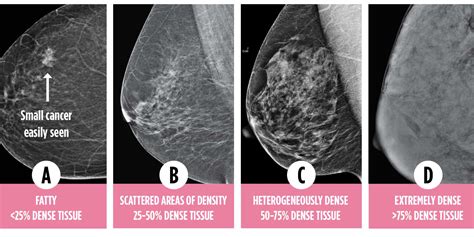 how breast density makes cancer harder to find canadian cancer