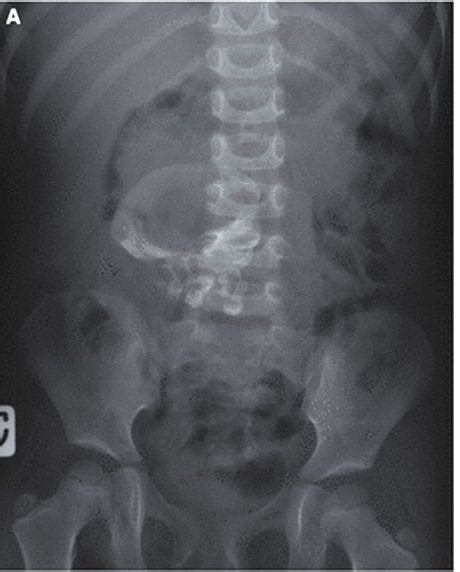 Skull Found In X Ray Of 3 Year Old Girl S Belly Wtf
