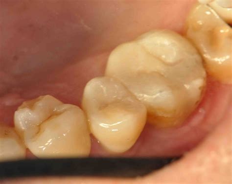 treatment options dental aesthetic  white filling ii   teeth