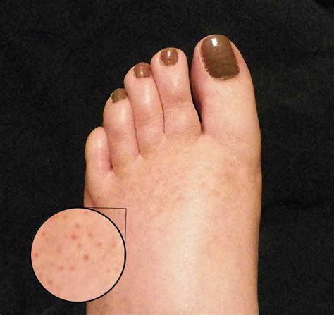 Tiny Red Spots Rash On Feet Collage Porn Video
