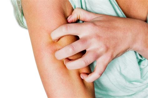 Scabies How To Treat And Survive The Seven Year Itch
