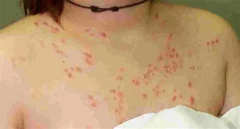 What Is Psoriasis And How To Treat It Contour Dermatology