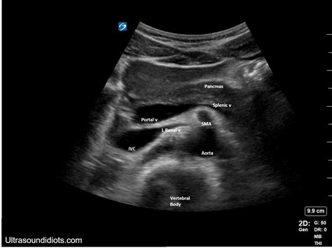 ultrasound idiots aorta