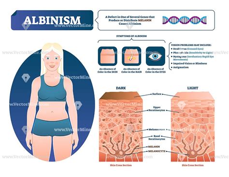 Albinism Vector Illustration – Vectormine Albinism Vision Problems