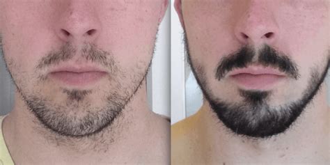 Homens Que Se Cuidam Minoxidil Na Barba Antes E Depois