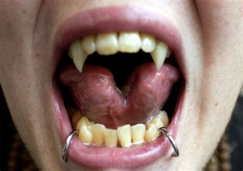 tongue splitting trend   dangerous health risks surgeons warn