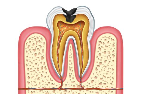 treatment  cavities abilene tx