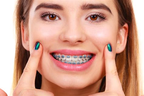 woman smiling showing teeth  braces brodsky orthodontics