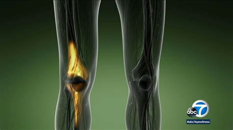 joint replacement    questions