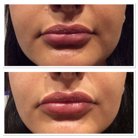 before and after cosmetic treatment gallery parfaire medical aesthetics
