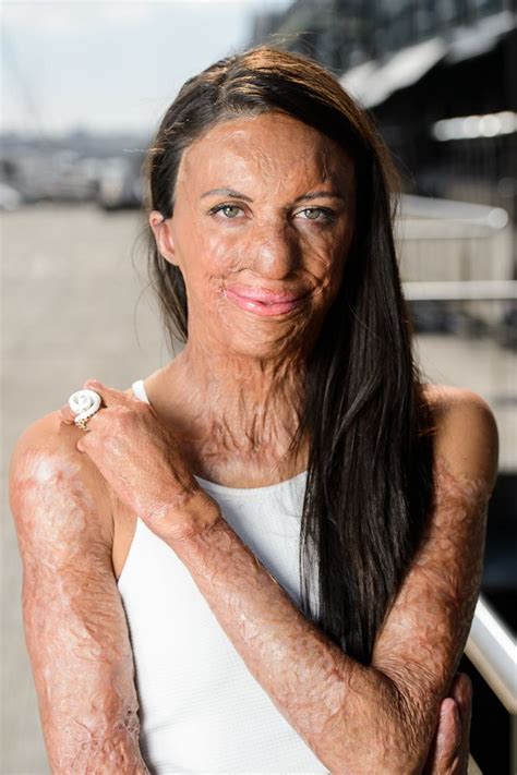 Turia Pitt Daily Mail Burn Survivor Fact Of The Day Beautiful Person