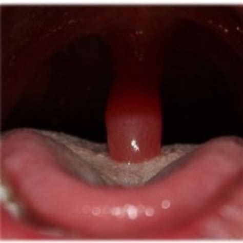 experience  uvulitis  fun patients lounge