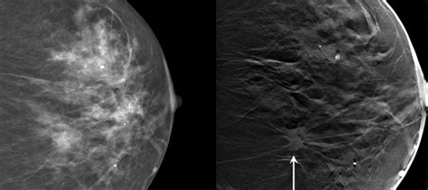 what is 3 d mammography duke health