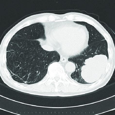 Chest Radiograph Showing A Rounded Mass Shadow In The Left Lower Lobe