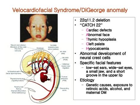 pin  nonas arc  digeorge syndrome digeorge syndrome medical