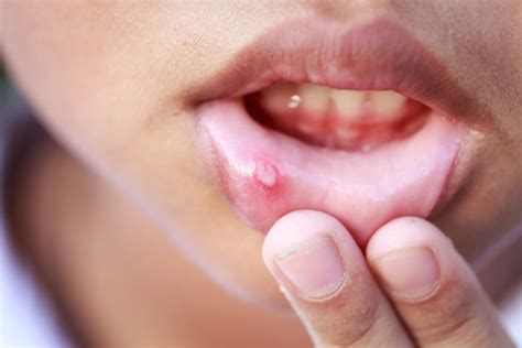 canker sores contagious family naturopathic clinic