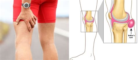 Do You Know What Causes Pain Behind The Knee And How To