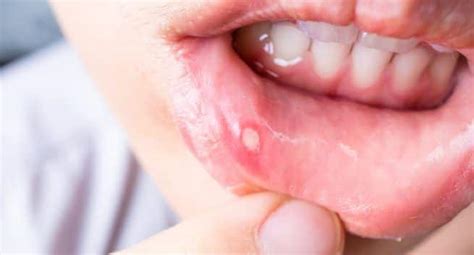 treat canker sores with these home remedies read health related blogs articles and news on