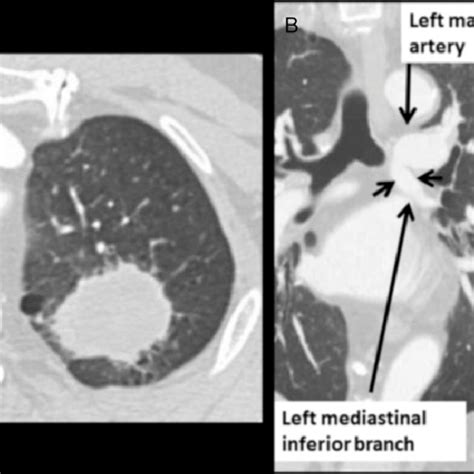 A Chest Ct Shows Lung Mass In The Left Upper Lobe B Chest