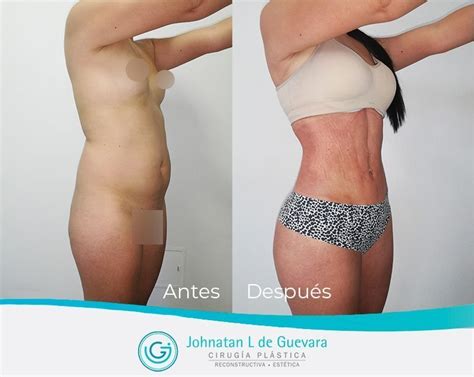 Brazilian Butt Lift Plastic Surgery Colombia Medical