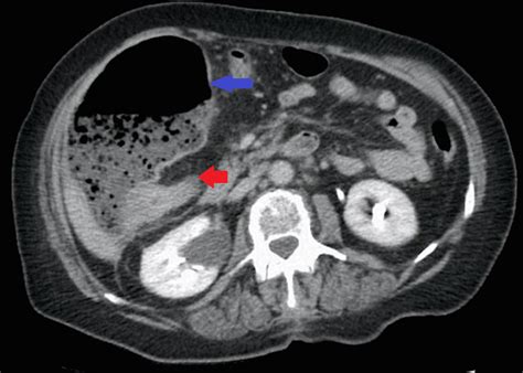 cureus colonic obstruction from an unusual cause a rare case of