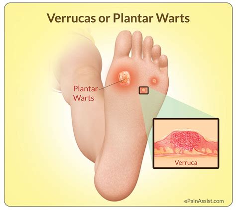 verrucas  plantar wartscausessymptomstreatment salicylic acid plasters