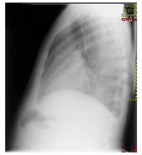 Locked Lung By Looped Hernia A Case Report Cases