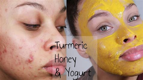 turmeric face mask  days  afters acne prone skin youtube