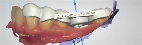 Digital Cbct Optical Scan Dental Implant Kazemi Oral